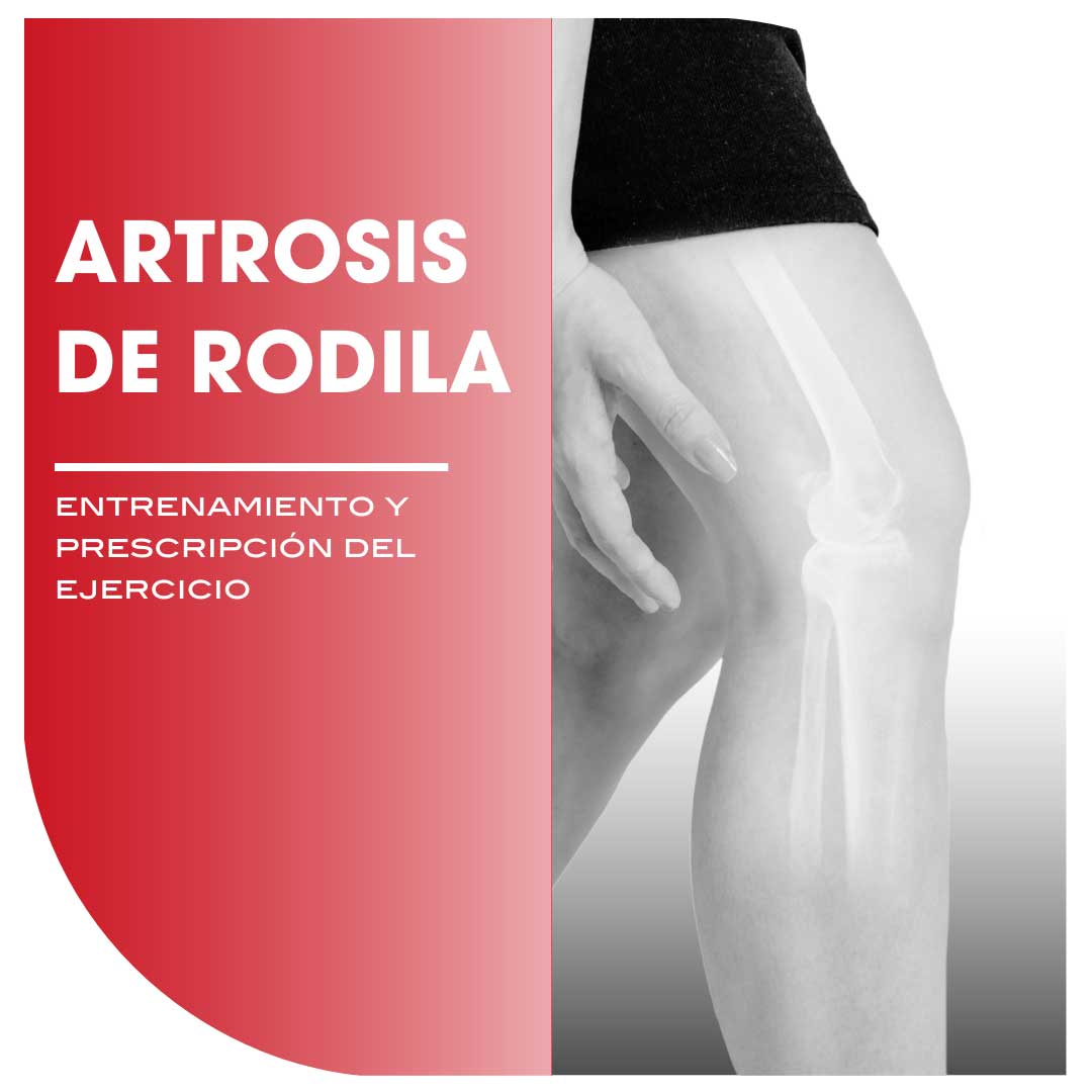 Artrosis de Rodilla